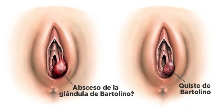 Quiste de Bartolino cirugía de urgencia