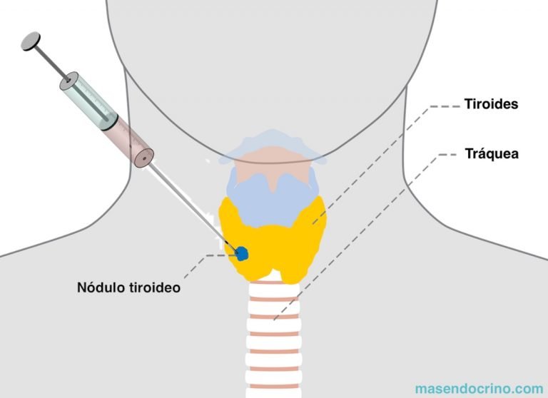 biopsia de tiroides