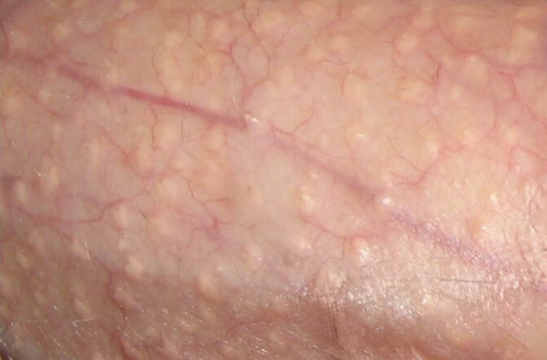 manchas de fordyce médicos especialistas atención de urgencia