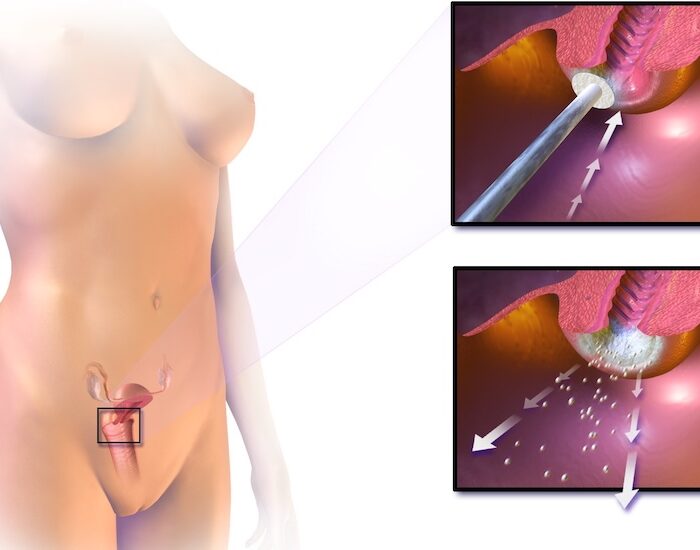 Crioterapia Cervical en providencia