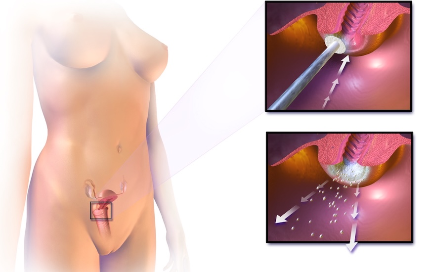 Crioterapia Cervical en providencia