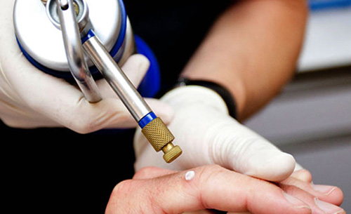 criocirugia lesiones íntimas