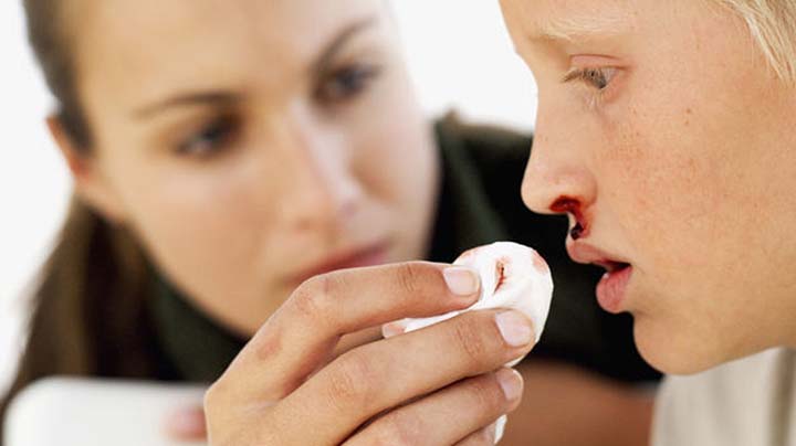 hemorragia nasal en niños