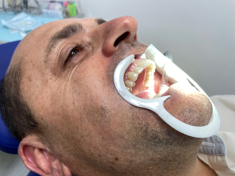 Absceso dental. dolor de dientes al morder