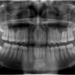 ortodoncia invisible alinea2