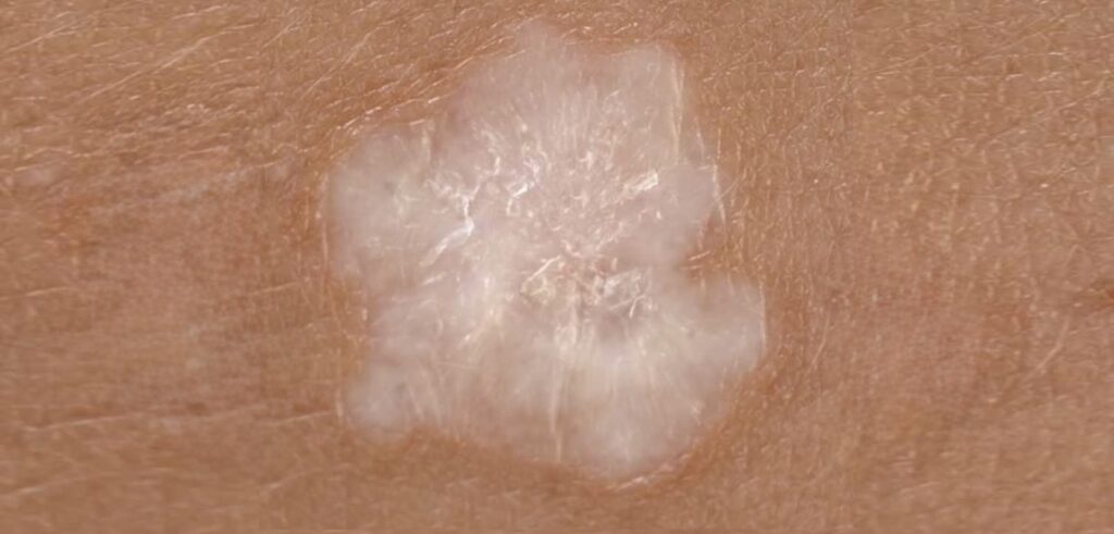 liquen escleroso médico especialista