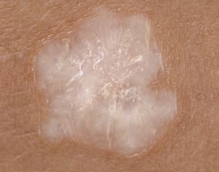 liquen escleroso médico especialista