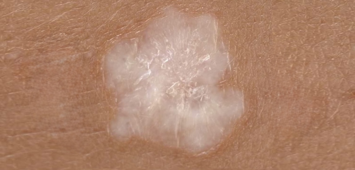 liquen escleroso médico especialista