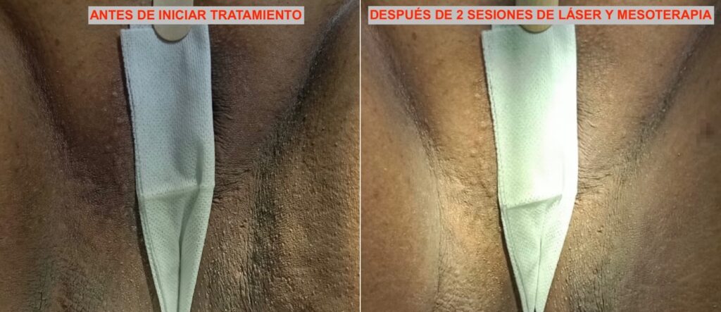 Blanqueamiento Genital tratamiento láser