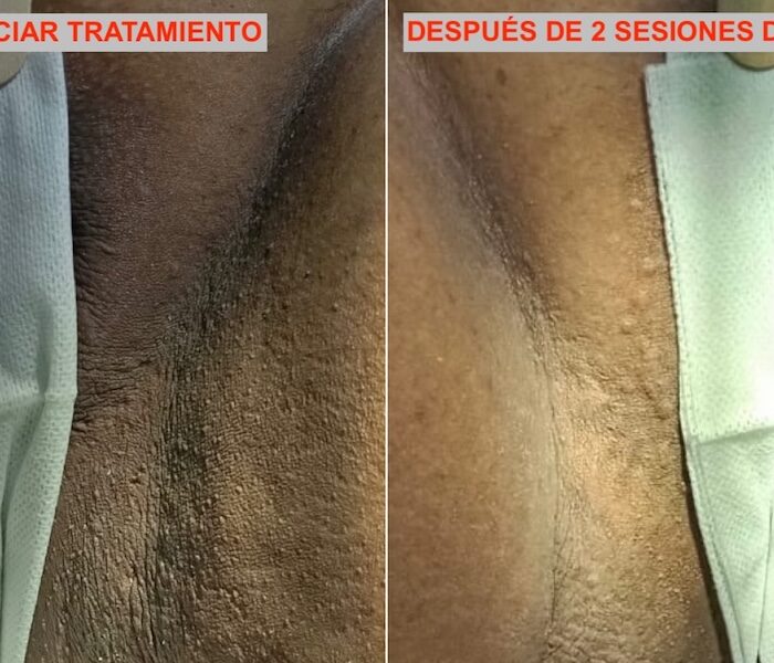 Blanqueamiento Genital tratamiento láser