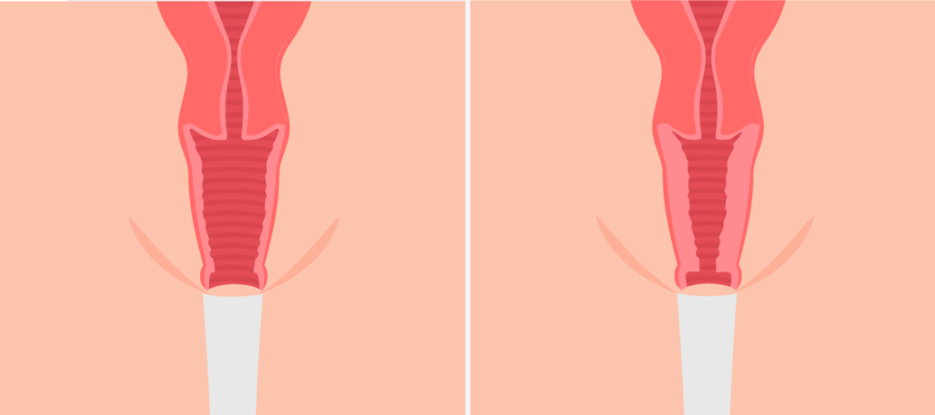 rejuvenecimiento vaginal interno