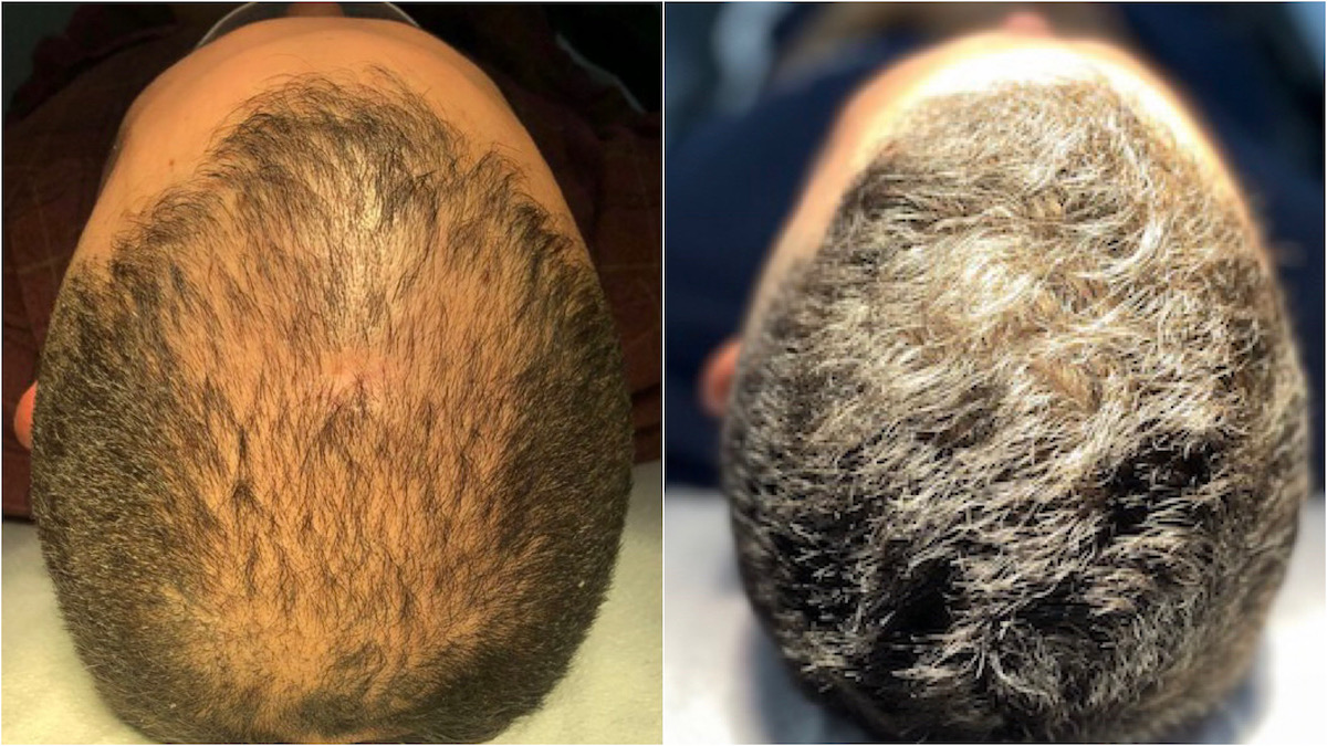 plan de recuperación capilar