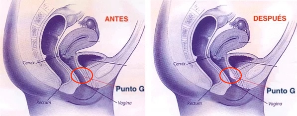 relleno de punto g con médico especialista