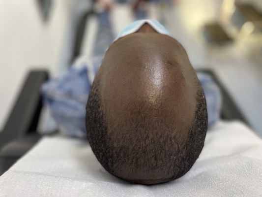 Alopecia androgénica. Tratamiento médico para caida del cabello