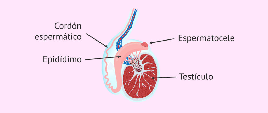 Quiste de Epidídimo cirugía en santiago