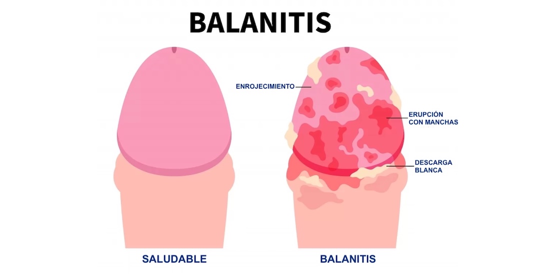 balanitis ATENCIÓN DE URGENCIA EN SANTIAGO