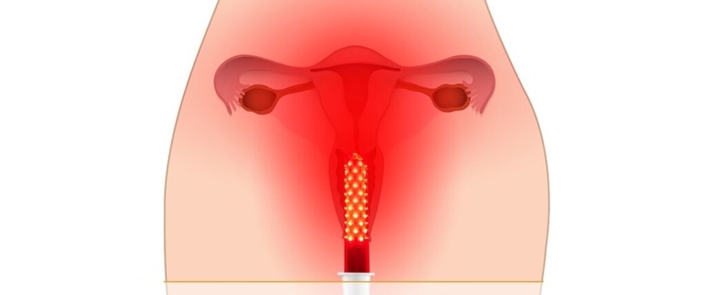 Fotomodulación Vaginal en santiago