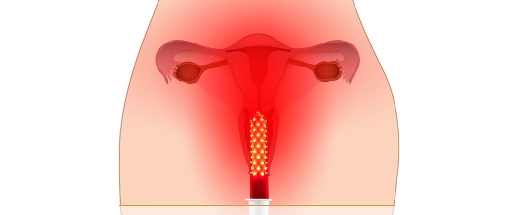 Fotomodulación Vaginal en santiago