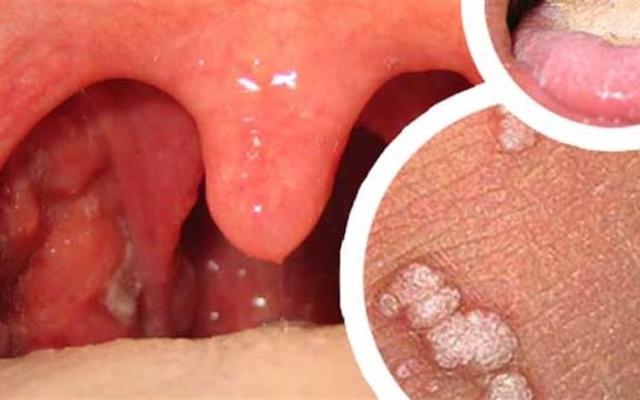 Virus del Papiloma en Cavidad Oral, verrugas en la boca