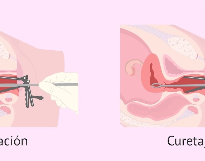 legrado uterino en santiago