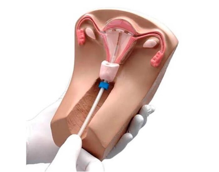 Retiro de DIU Incrustado​ médico de urgencia