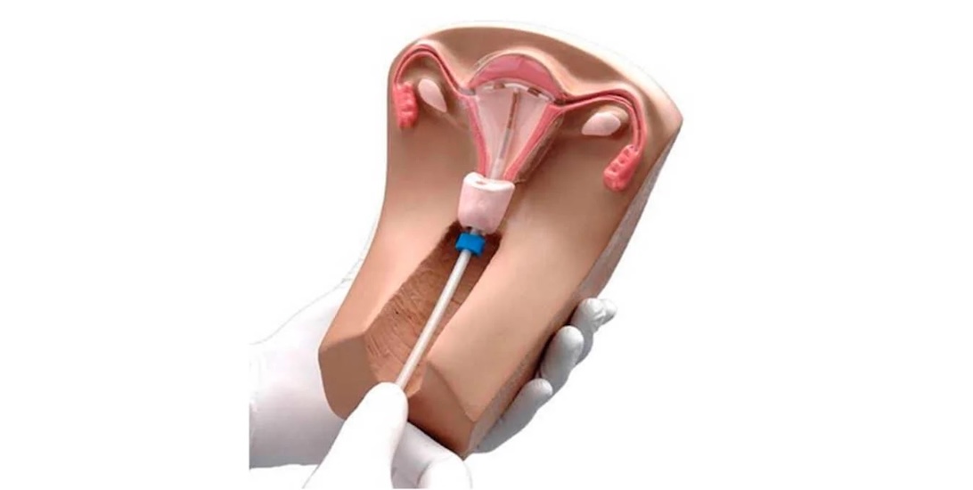 Retiro de DIU Incrustado​ médico de urgencia