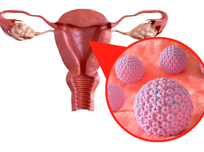 conización de cuello uterino. cáncer de cuello uterino