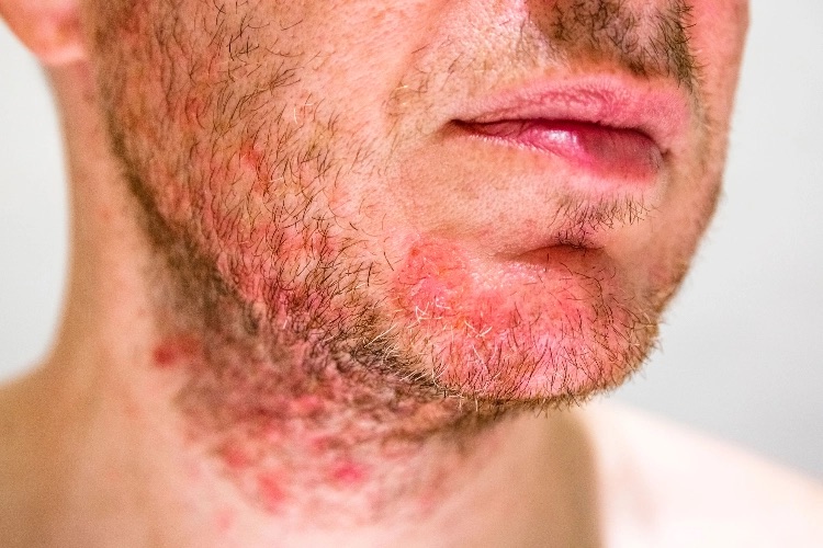 hidradenitis supurativa facial tratamiento láser