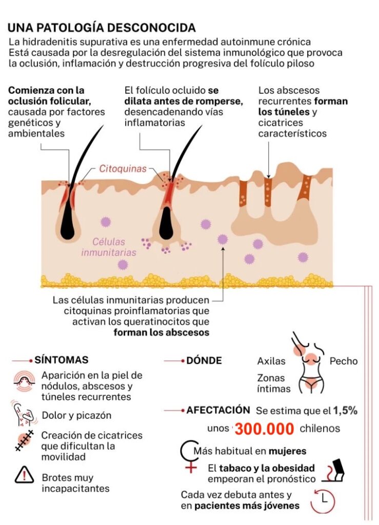 hidradermitis supurativa facial