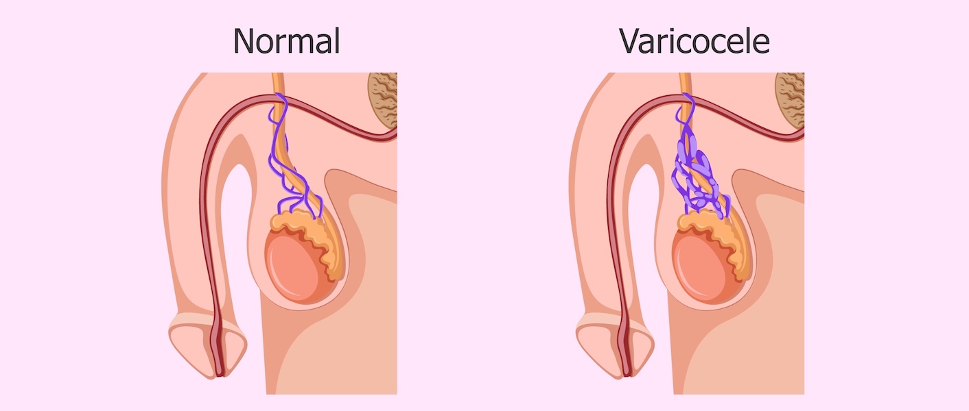 varicocele cirugía de urgencia