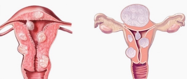 FIBROMAS UTERINOS médico especialista