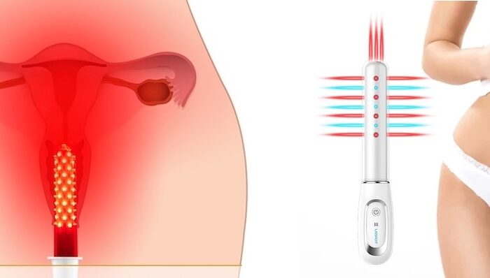Fototerapia LED Vaginal en santiago