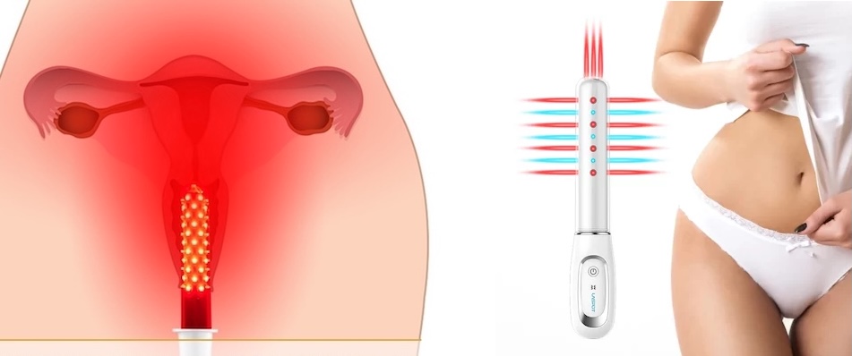 Fototerapia LED Vaginal en santiago