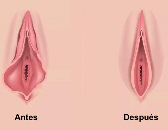 NINFOPLASTÍA ambulatoria en santiago