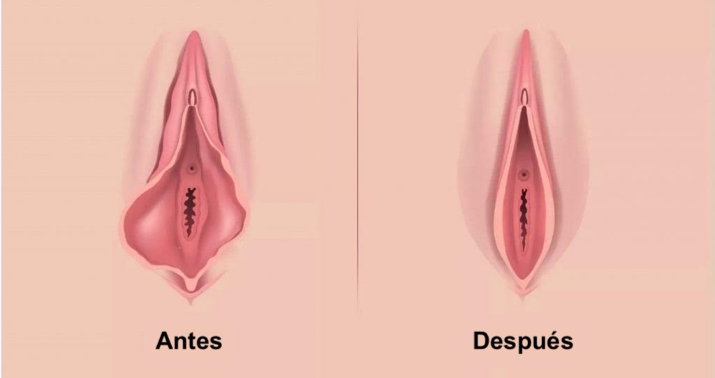 NINFOPLASTÍA ambulatoria en santiago