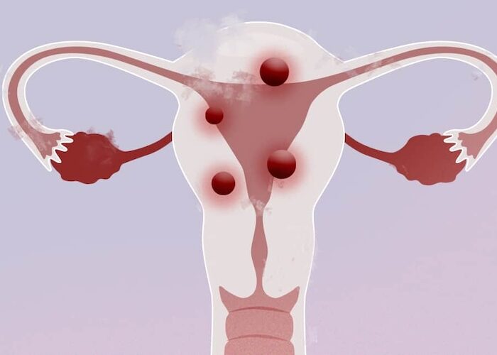 tumores no cancerígenos en el útero