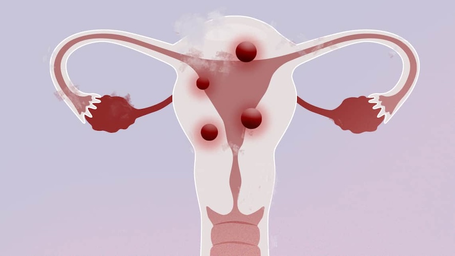 tumores no cancerígenos en el útero