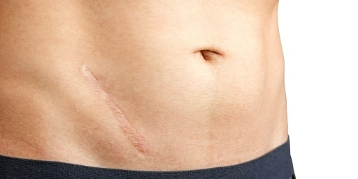 cicatriz por apendicitis tratamiento médico láser