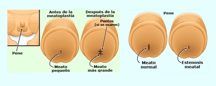 Meatotomía cirugía ambulatoria