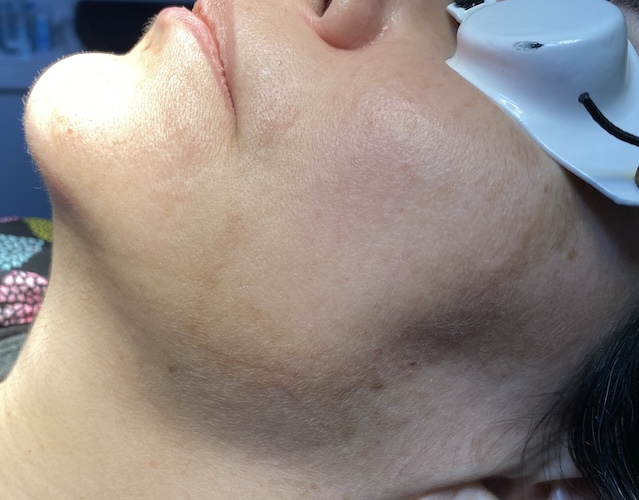 melasma y tratamiento láser harmony