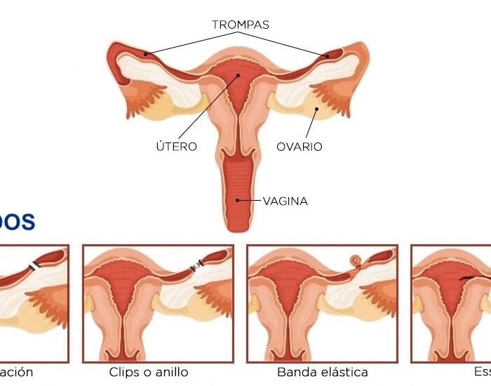 Ligadura de Trompas de falopio en providencia