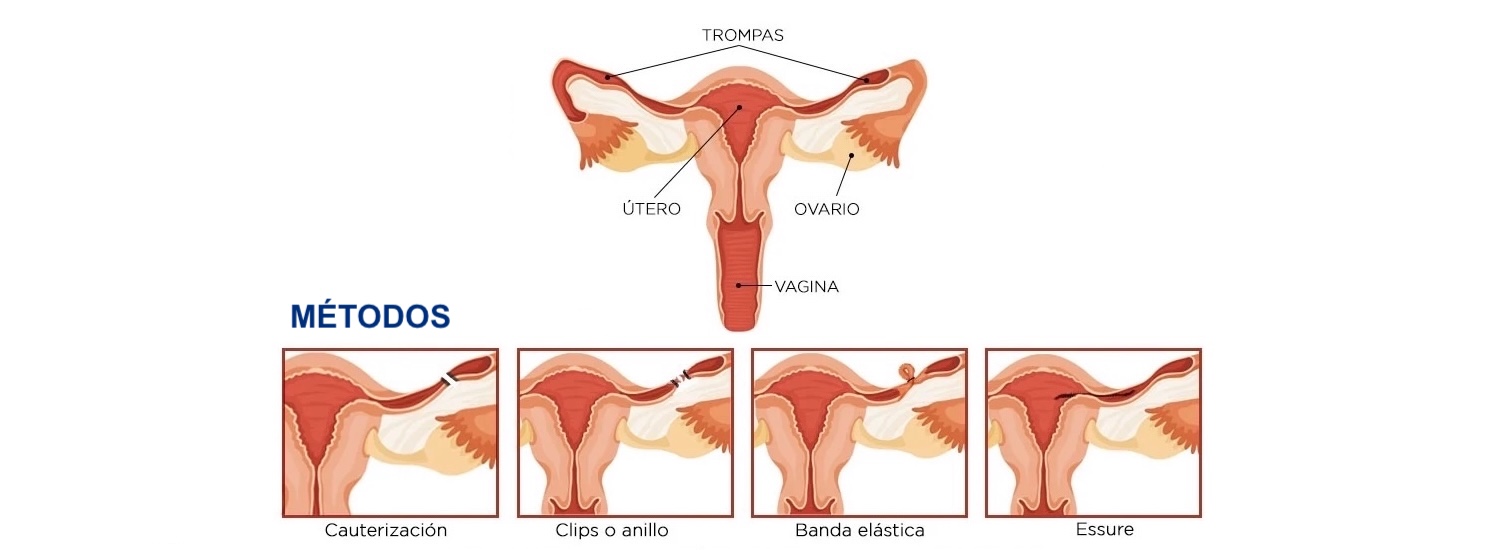 Ligadura de Trompas de falopio en providencia