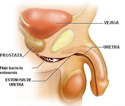 meatotomía