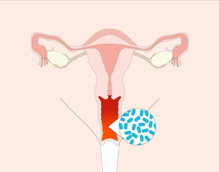 ozonoterapia ginecológica para candida recurrente