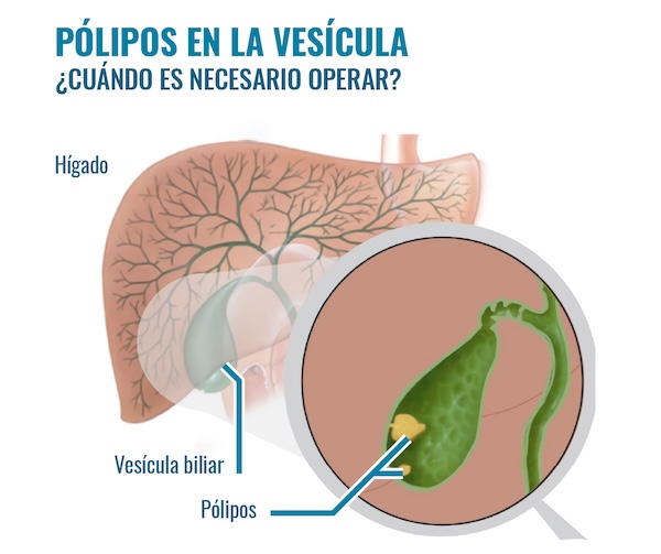 pólipos vesiculares y cirugía ambulatoria inmediata