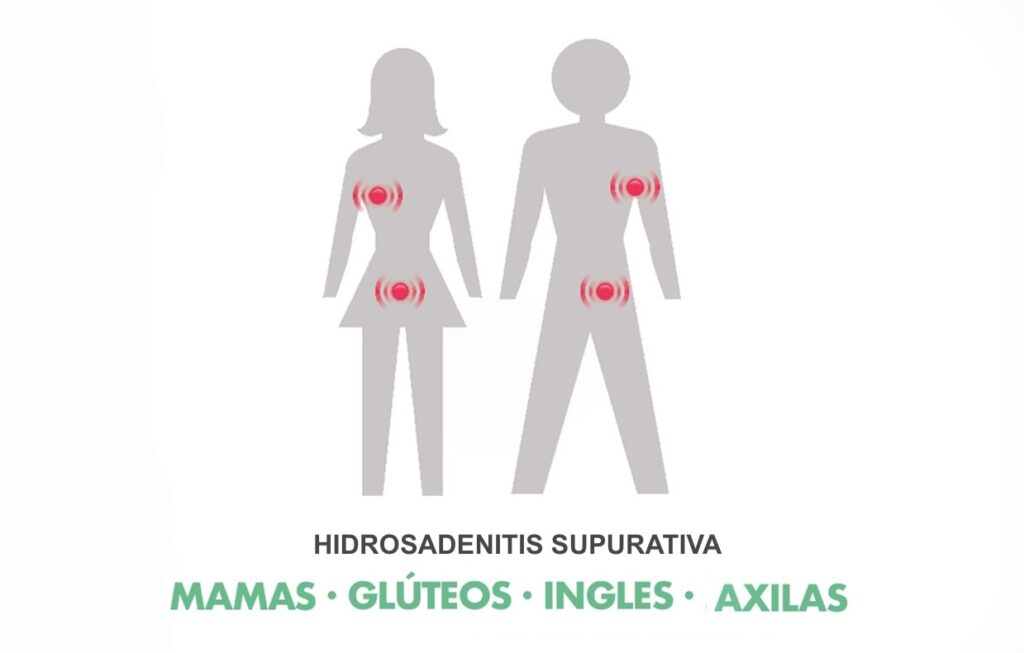 Hidradenitis Supurativa Mamaria atención médica especialista