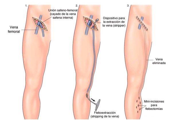 Safenectomía o Stripping cirugía ambulatoria