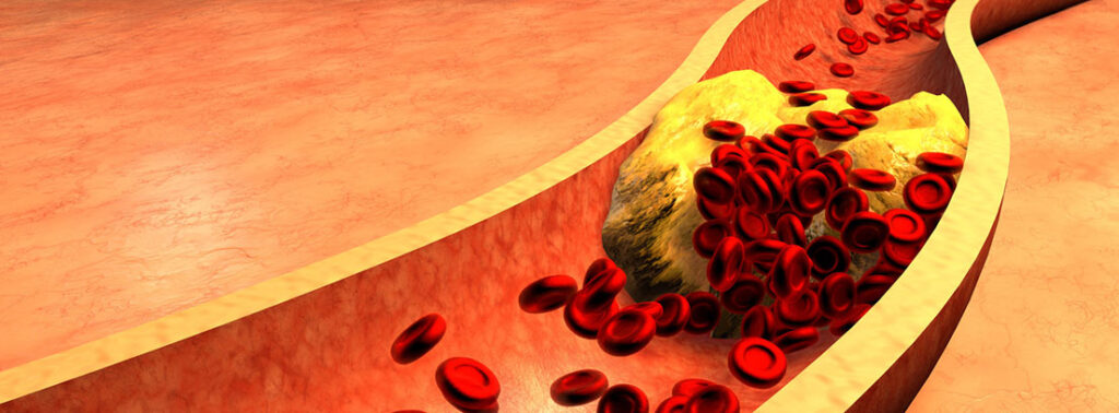 aterosclerosis y cirujano vascular