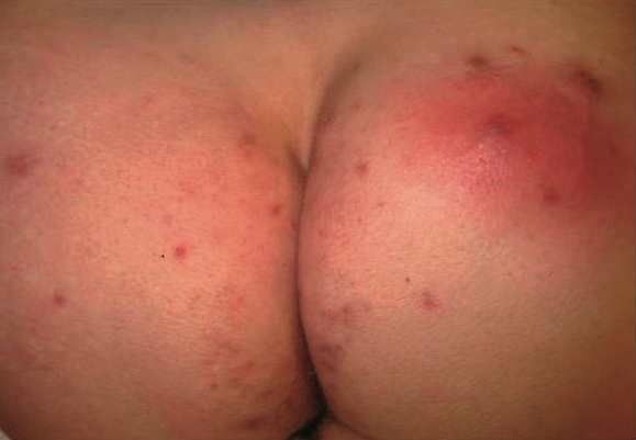 Hidradenitis Supurativa en Glúteos tratamiento con dermatólogo