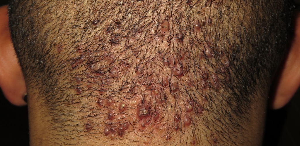 hidradenitis supurativa en la nuca tratamiento médico